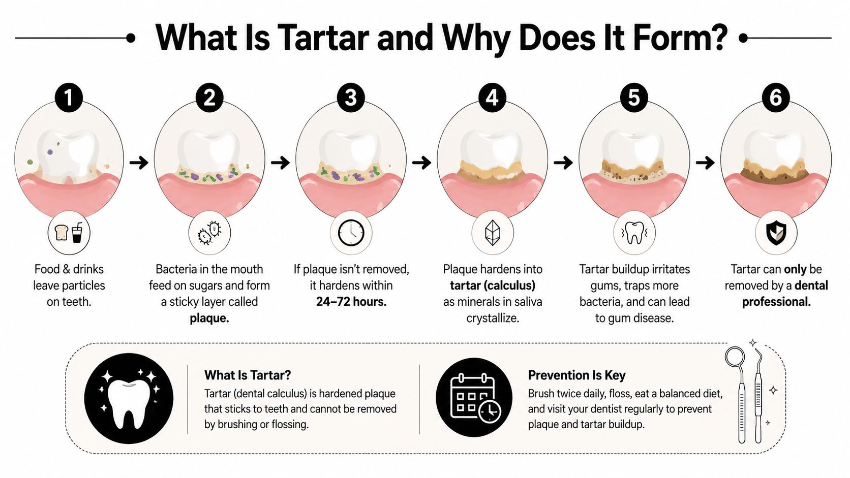 A six-step infographic illustrating how food particles, plaque, and bacteria develop into tartar on teeth over time.
