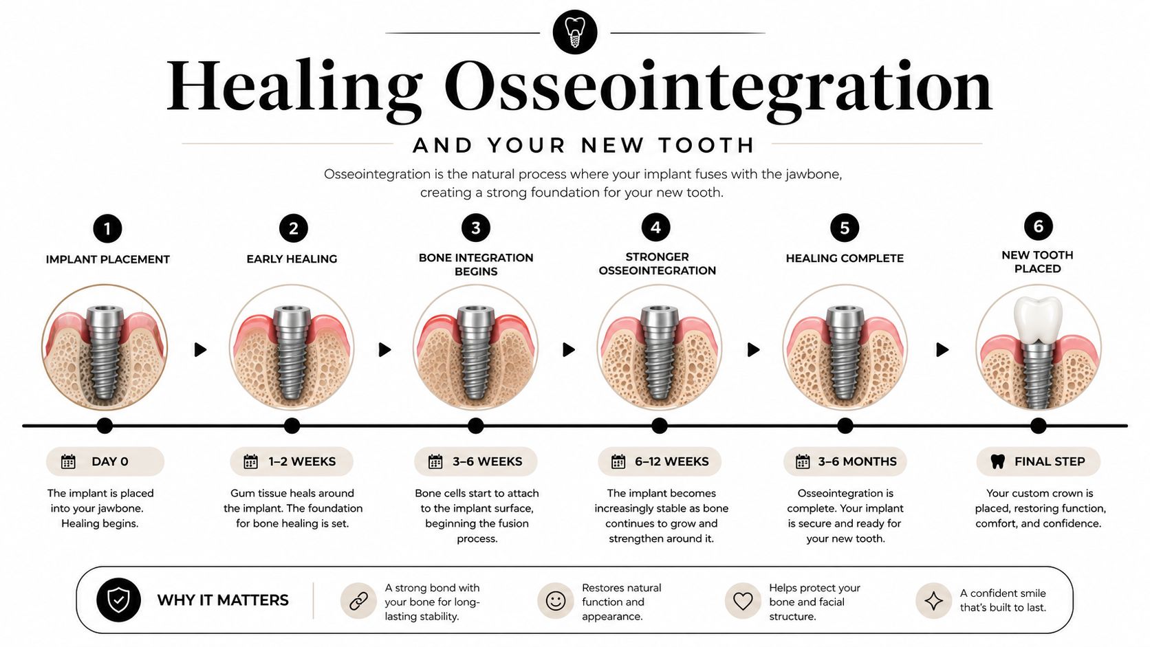 A dental infographic timeline illustrating the six-step process of tooth implant placement and osseointegration over several months.