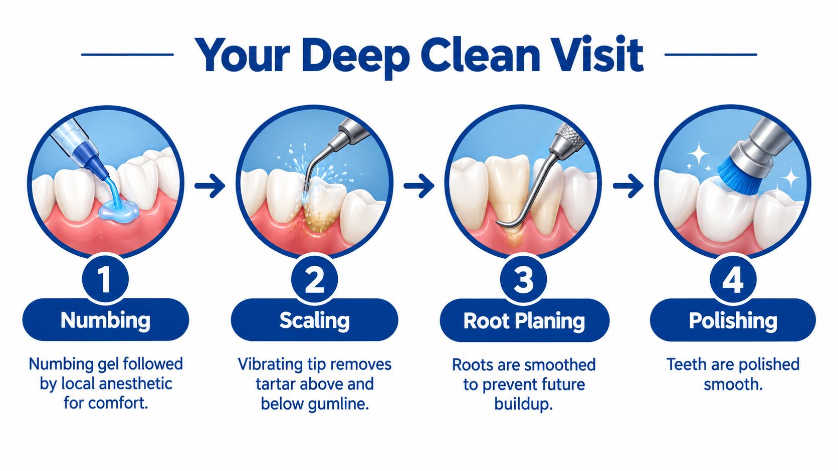 A four-step infographic illustrating the professional deep cleaning procedure for dental hygiene, including numbing, scaling, root planing, and polishing.