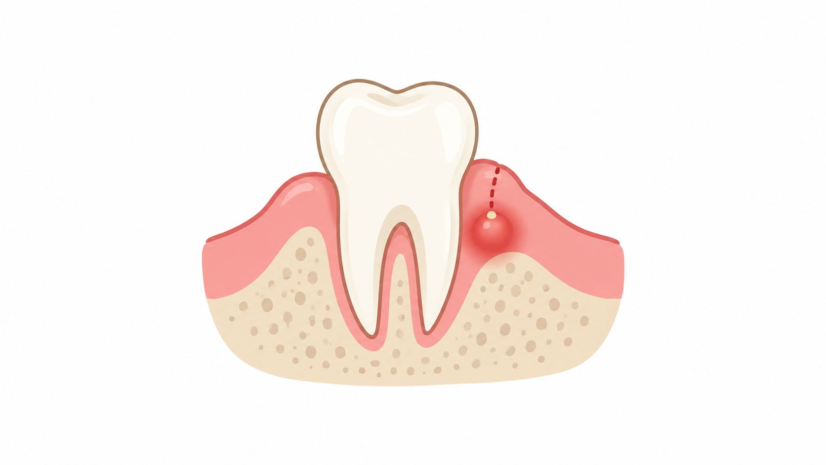 A dental illustration showing a tooth with an inflamed gum abscess and a root canal infection.
