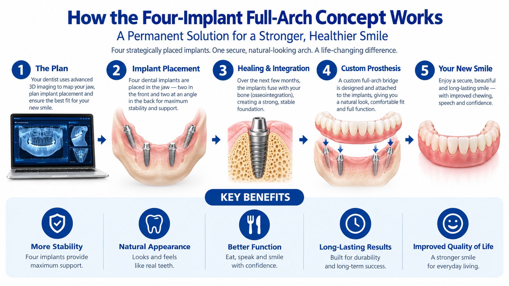 A step-by-step infographic illustrating the four-implant full-arch dental procedure from planning to the final smile.