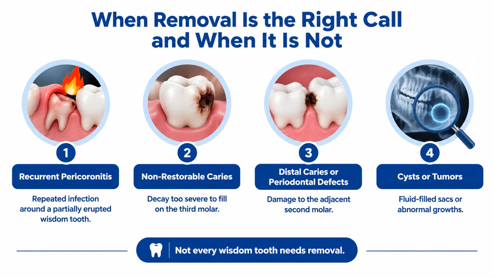 An infographic detailing four specific medical reasons why a dentist might recommend wisdom tooth removal surgery.