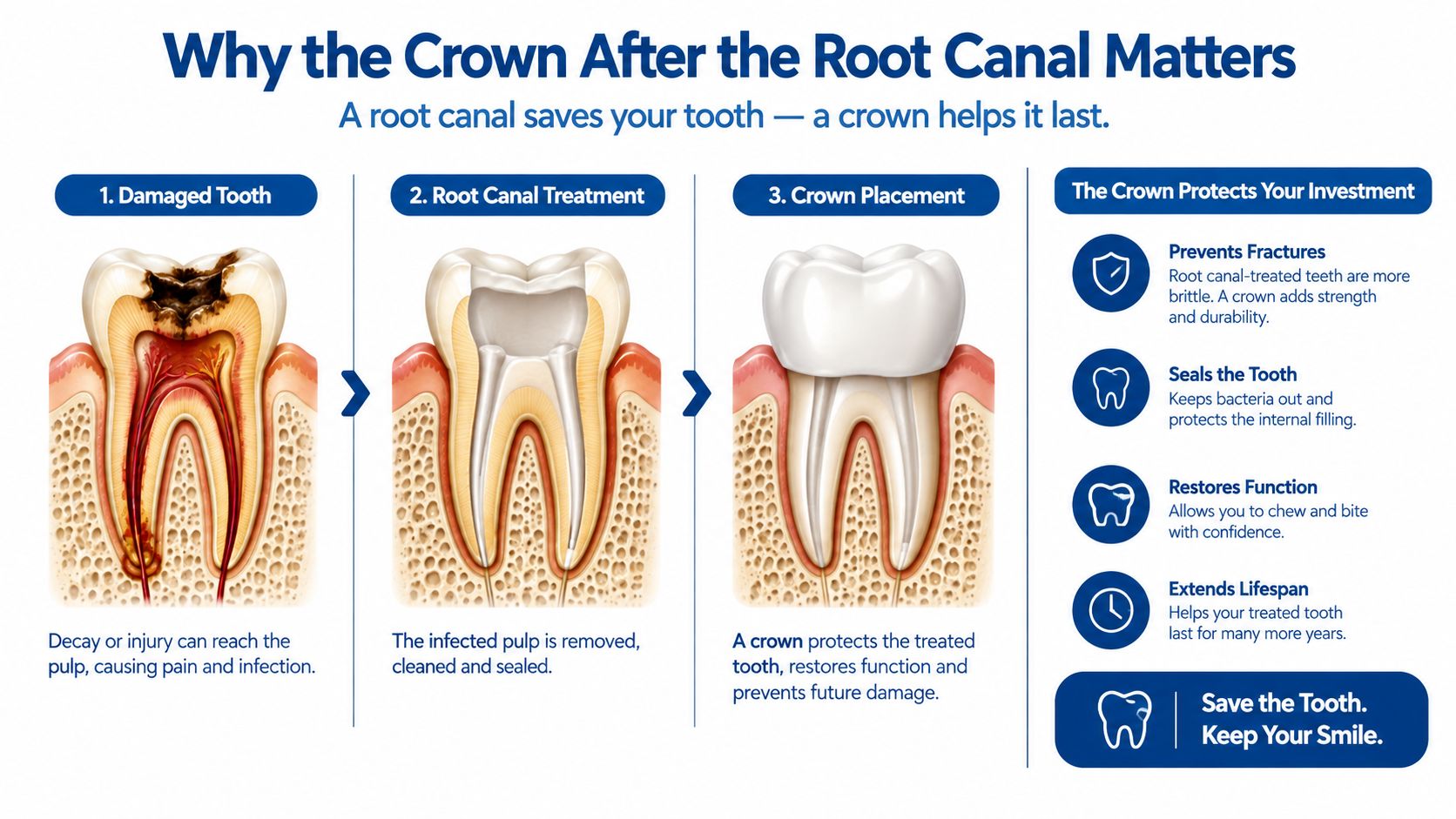 An infographic illustrating the dental procedure of a root canal and why a crown is necessary afterward.