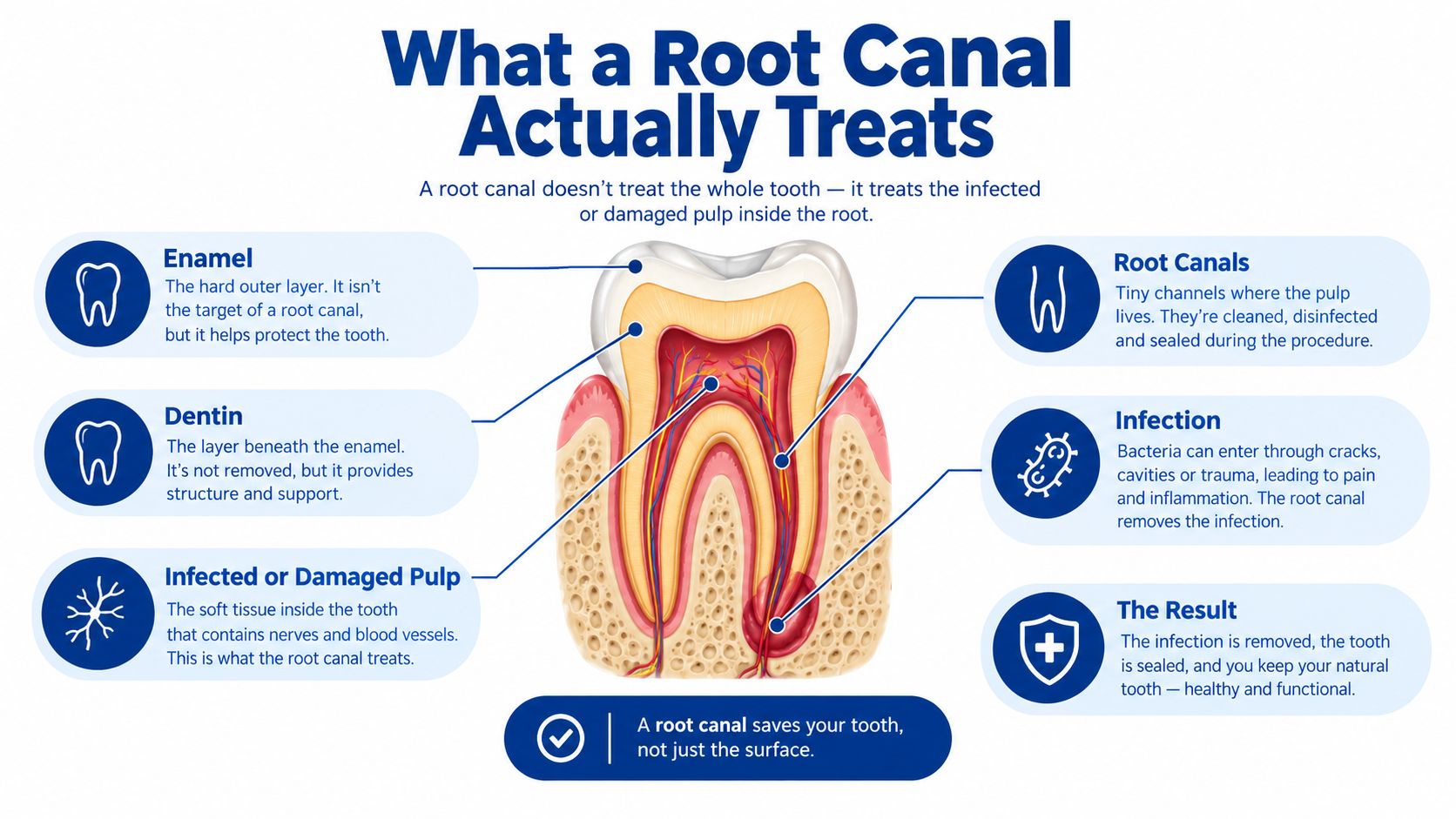 A diagram illustrating the anatomy of a human tooth and the root canal treatment procedure process.