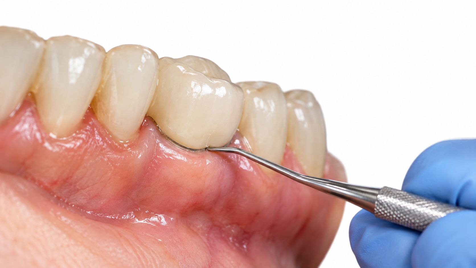 A dentist using a metal probe to examine a dental crown near the patient's gum line.